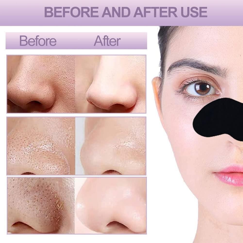 Blackhead Remover Strips (Pack of 20)